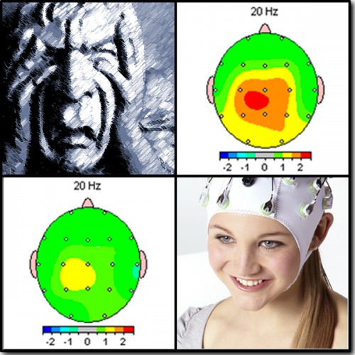 MigraineTreatment