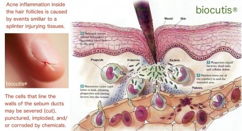 acne-inflammation-injuries