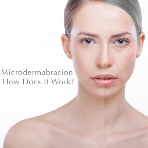 MicrodermabrasionHome.com Enlightens Readers About Microdermabrasion