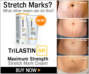 Defeat Stretch Marks Publishes New Review Of Trilastin Cream For Stretches, Scars and Marks