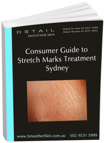 Smoother Skin Clinic Sydney Releases Free Guide to Stretch Marks Treatment