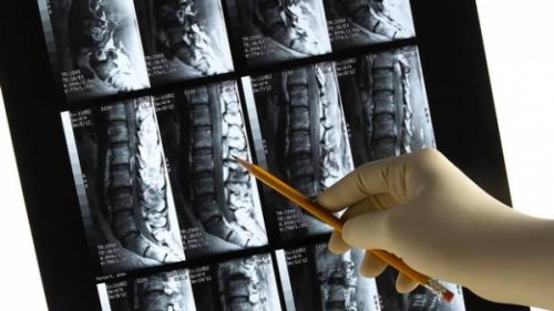 Back Surgery Avoided For Severe Back Pain Sufferers-Spinal Decompression Therapy