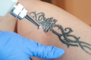 Dallas Fort Worth DFW Tattoo Removal Laser Ink Treatment Services Launched