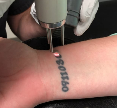 Best Laser Tattoo Removal Michigan | California | Skin & Vein Center