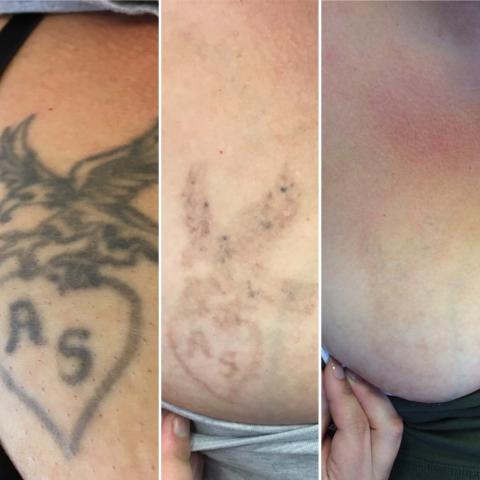 Quicker Tattoo Removal Technology Comes to Phoenix