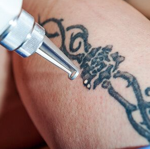 Tattoo Removal  Washington DC  Center for Laser Surgery