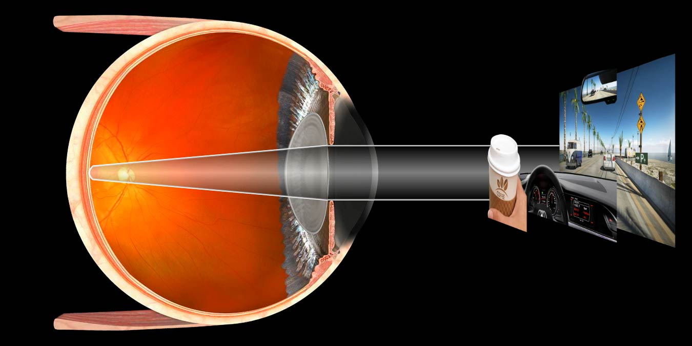 Близорукость (intraocular lens). Искусственный кристаллик ukfp. Intraocular lens. Intraocular lens. Факичные интраокулярные линзы.