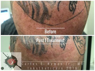 Laser Tattoo Removal Before  After Photos  LaserSpa of Tampa Bay