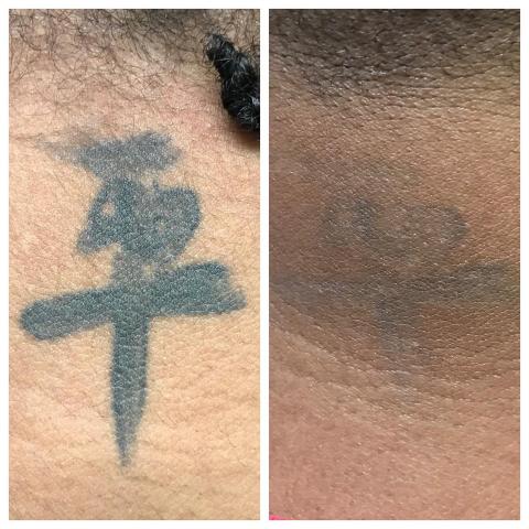 Home  DFW Tattoo Removal