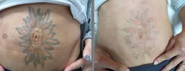 Lexington Tattoo Removal  Introducing Sidney CLT CLTRS  Facebook