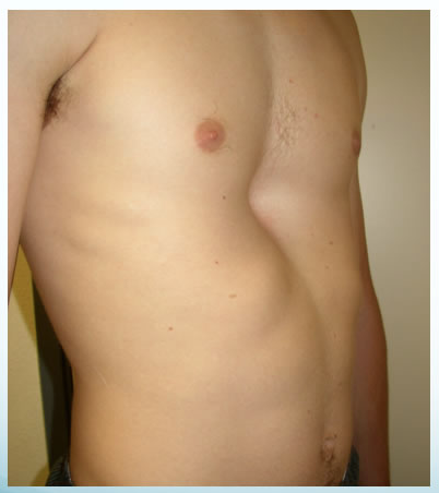 Sunken Chest Syndrome, Or Pectus Excavatum, Affects 1 in 300-400 Kids -  Digital Journal